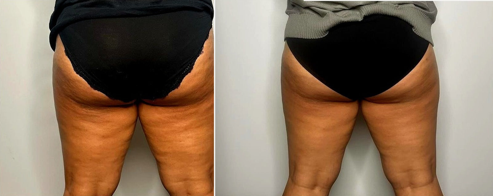 Avant/Après — réduction visible de cellulite et raffermissement des fessiers